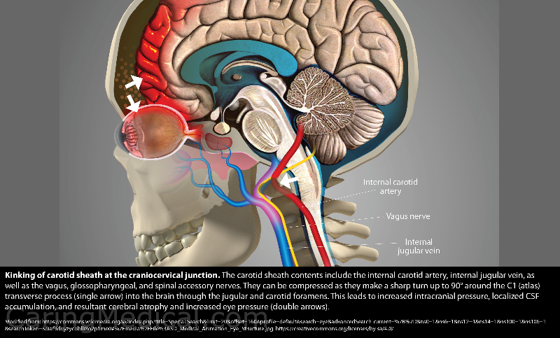 Physical Stress Vagus Nerve Compression and CFS Compression